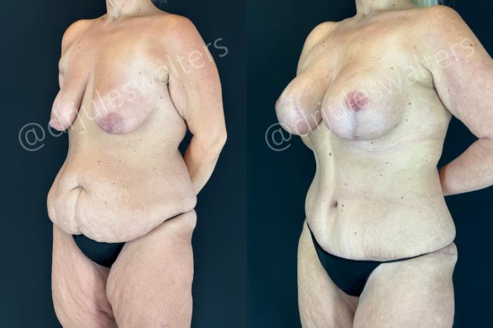 Before & After Mommy Makeover Case 190 Left Oblique View in Metairie and New Orleans, LA