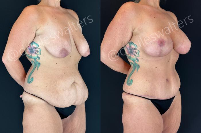 Before & After Mommy Makeover Case 190 Right Oblique View in Metairie and New Orleans, LA