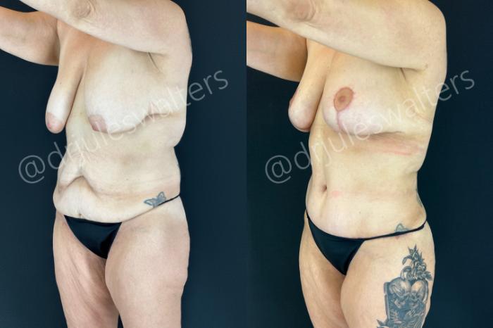 Before & After Mommy Makeover Case 203 Left Oblique View in Metairie and New Orleans, LA