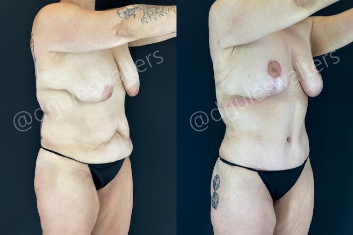 Before & After Mommy Makeover Case 203 Right Oblique View in Metairie and New Orleans, LA