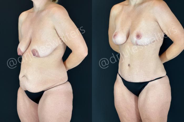 Before & After Mommy Makeover Case 205 Left Oblique View in Metairie and New Orleans, LA