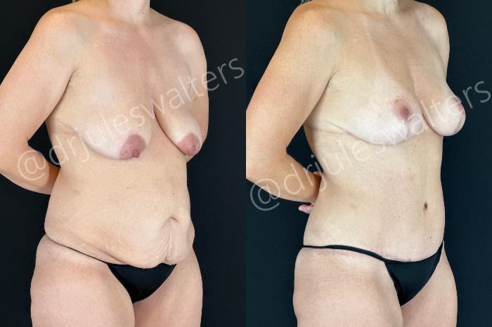 Before & After Mommy Makeover Case 205 Right Oblique View in Metairie and New Orleans, LA