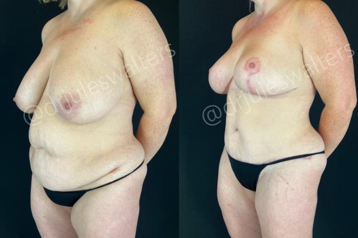 Before & After Mommy Makeover Case 207 Left Oblique View in Metairie and New Orleans, LA