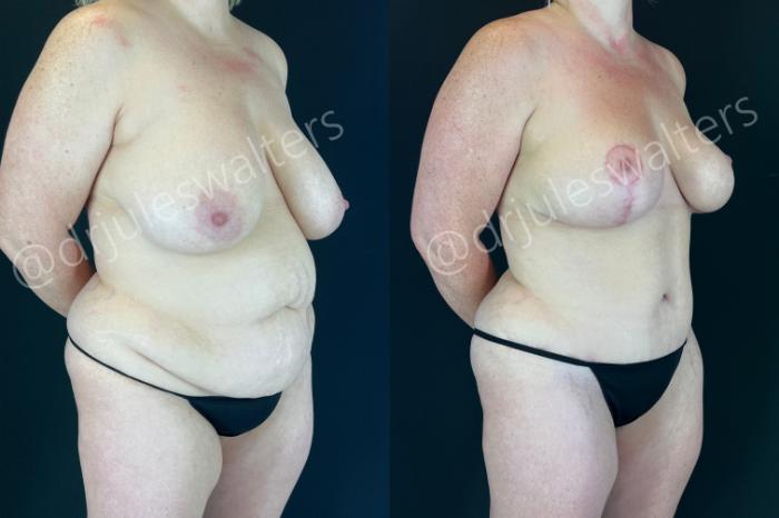 Before & After Mommy Makeover Case 207 Right Oblique View in Metairie and New Orleans, LA