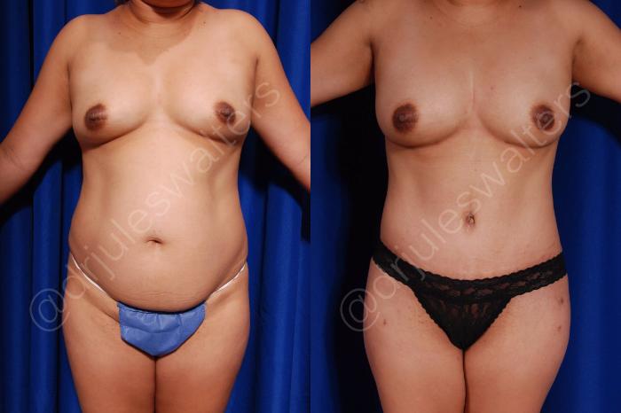 Before & After Tummy Tuck Case 22 View #1 View in Metairie and New Orleans, LA