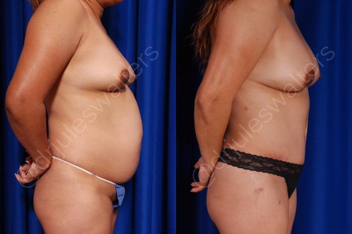 Before & After Liposuction Case 22 View #2 View in Metairie and New Orleans, LA