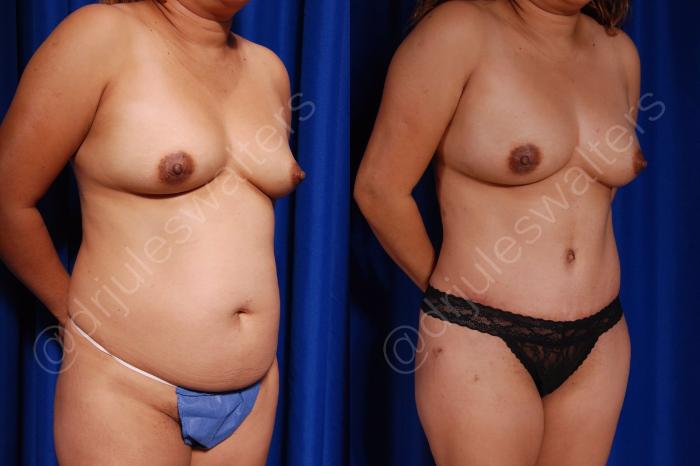 Before & After Tummy Tuck Case 22 View #4 View in Metairie and New Orleans, LA
