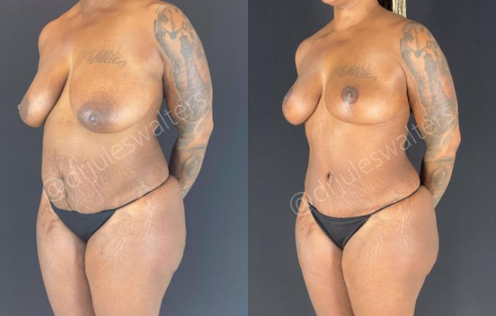 Before & After Liposuction Case 47 View #1 View in Metairie and New Orleans, LA