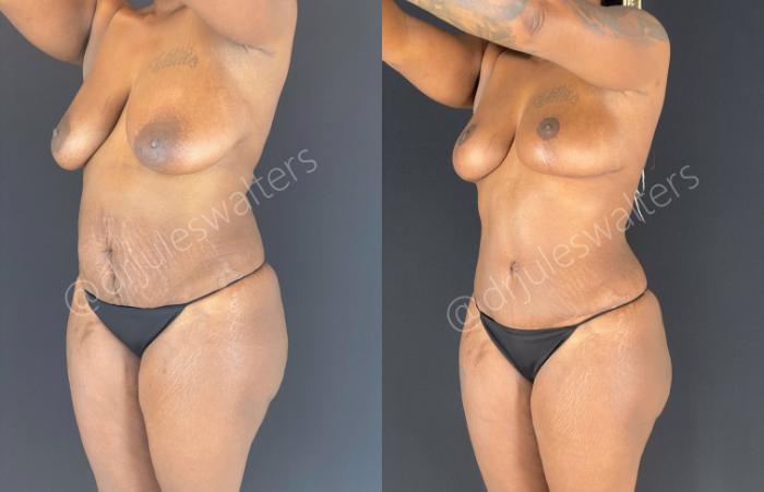 Before & After Liposuction Case 47 View #2 View in Metairie and New Orleans, LA