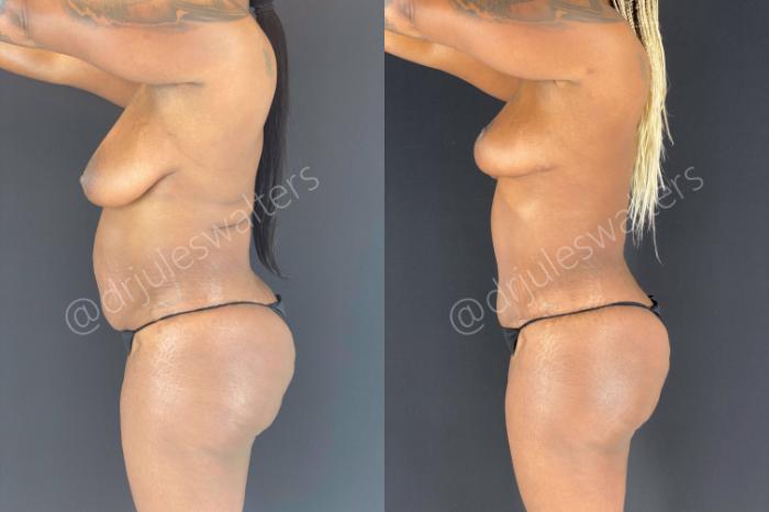 Before & After Liposuction Case 47 View #3 View in Metairie and New Orleans, LA