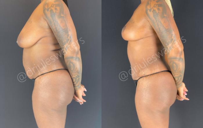Before & After Tummy Tuck Case 47 View #4 View in Metairie and New Orleans, LA