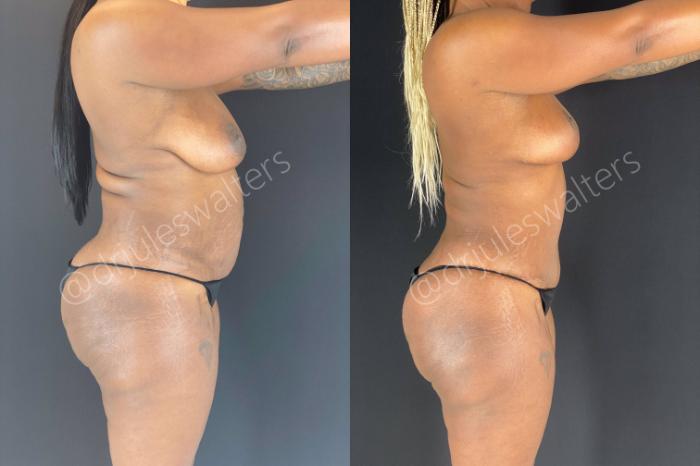 Before & After Liposuction Case 47 View #5 View in Metairie and New Orleans, LA