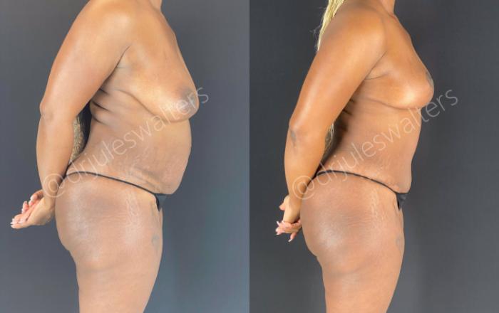 Before & After Tummy Tuck Case 47 View #6 View in Metairie and New Orleans, LA