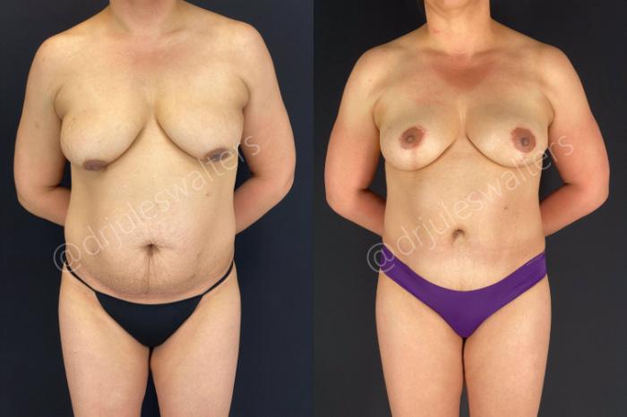 Before & After Tummy Tuck Case 48 View #1 View in Metairie and New Orleans, LA