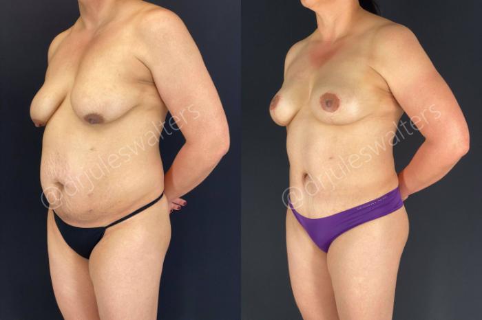 Before & After Tummy Tuck Case 48 View #2 View in Metairie and New Orleans, LA