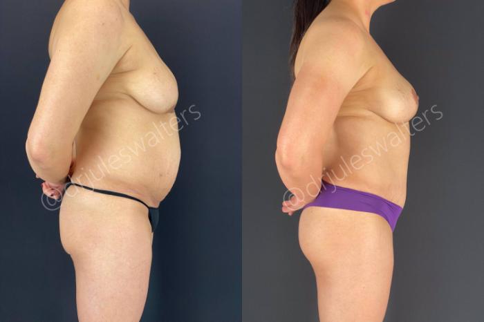 Before & After Tummy Tuck Case 48 View #3 View in Metairie and New Orleans, LA