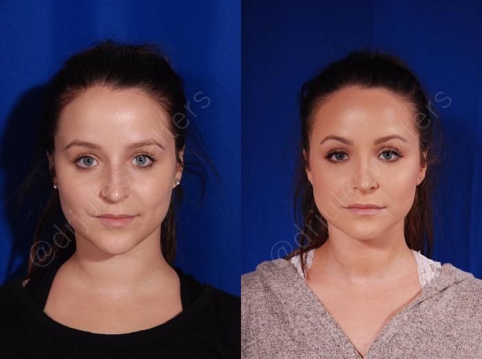 Before & After Rhinoplasty Case 136 View #1 View in Metairie and New Orleans, LA