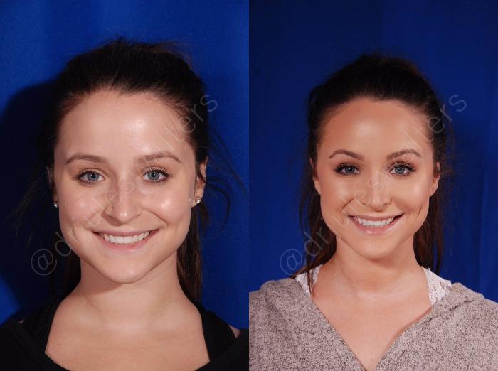 Before & After Rhinoplasty Case 136 View #2 View in Metairie and New Orleans, LA