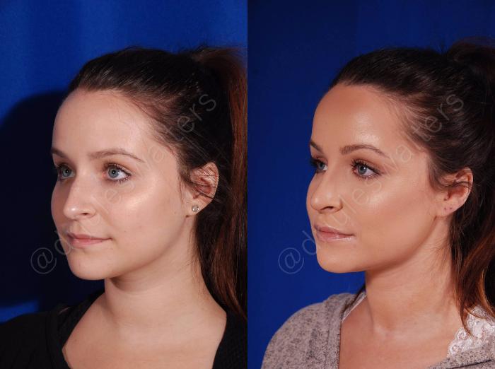 Before & After Rhinoplasty Case 136 View #3 View in Metairie and New Orleans, LA
