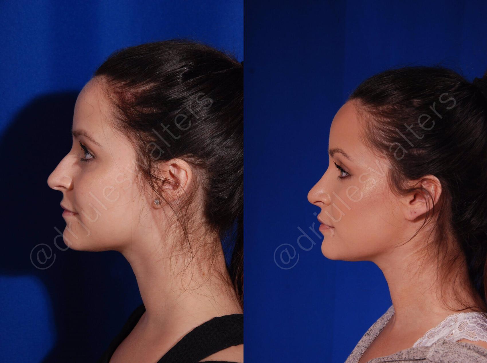 Before & After Rhinoplasty Case 136 View #4 View in Metairie and New Orleans, LA
