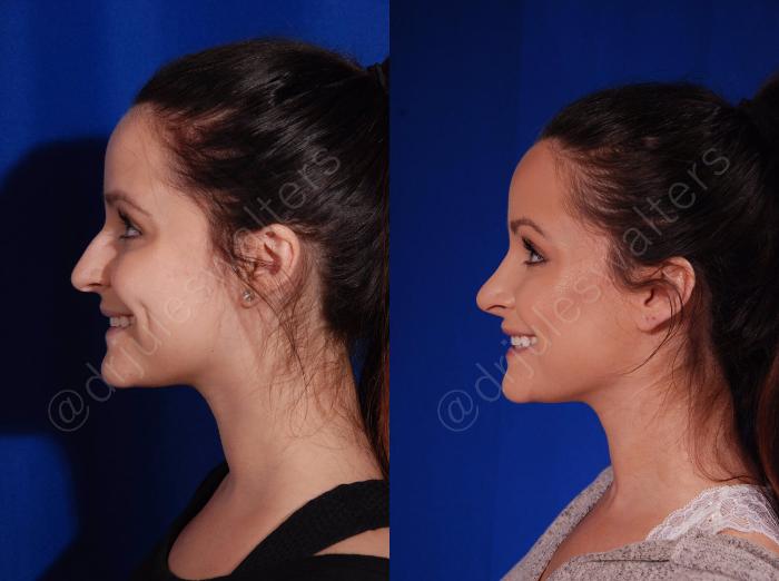 Before & After Rhinoplasty Case 136 View #5 View in Metairie and New Orleans, LA