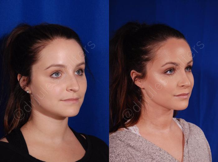 Before & After Rhinoplasty Case 136 View #6 View in Metairie and New Orleans, LA