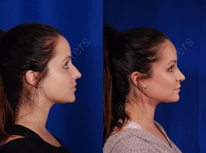 Before & After Rhinoplasty Case 136 View #7 View in Metairie and New Orleans, LA