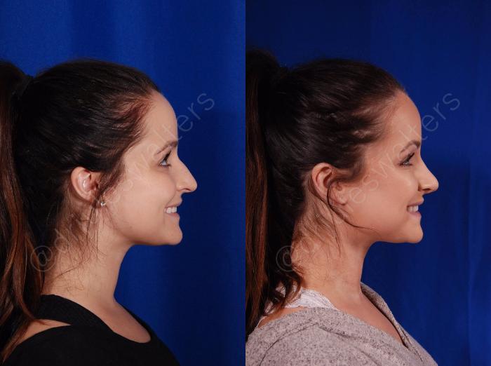 Before & After Rhinoplasty Case 136 View #8 View in Metairie and New Orleans, LA