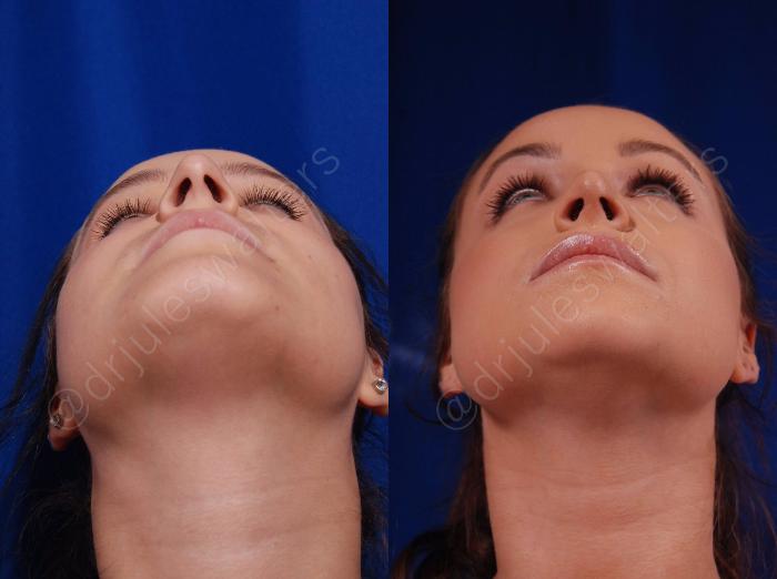 Before & After Rhinoplasty Case 136 View #9 View in Metairie and New Orleans, LA