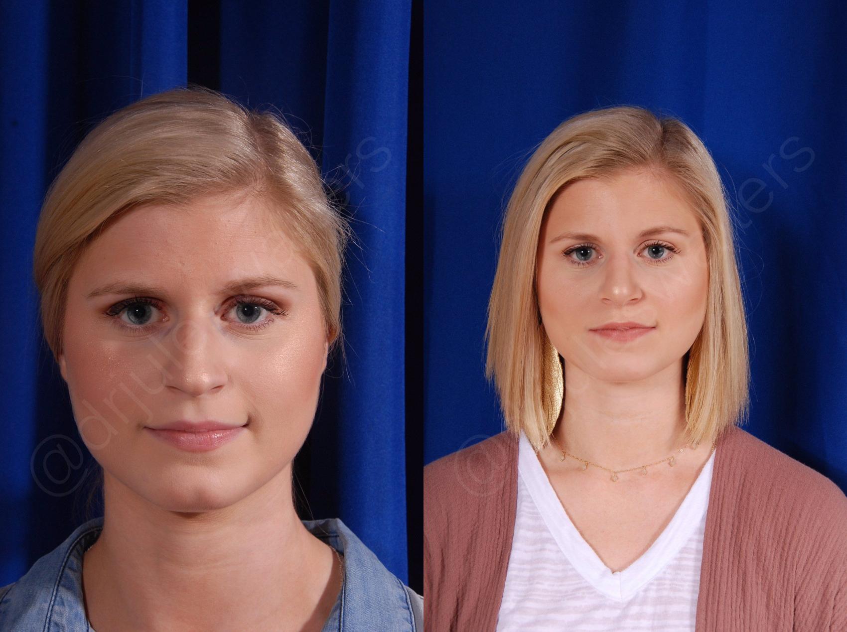 Before & After Rhinoplasty Case 137 View #1 View in Metairie, New Orleans, Covington, LA