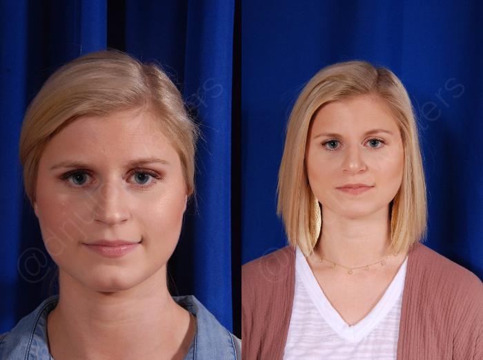 Before & After Rhinoplasty Case 137 View #1 View in Metairie and New Orleans, LA