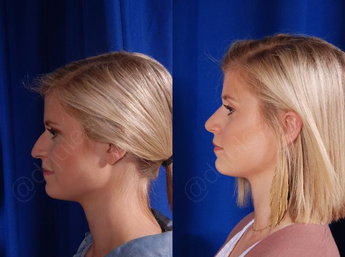 Before & After Rhinoplasty Case 137 View #2 View in Metairie and New Orleans, LA