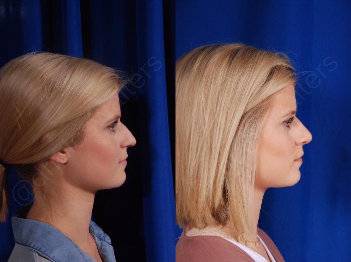 Before & After Rhinoplasty Case 137 View #3 View in Metairie and New Orleans, LA
