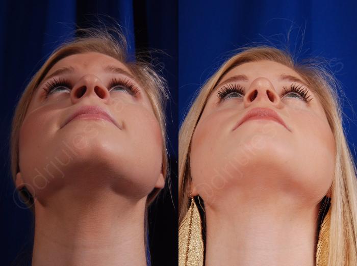 Before & After Rhinoplasty Case 137 View #6 View in Metairie and New Orleans, LA