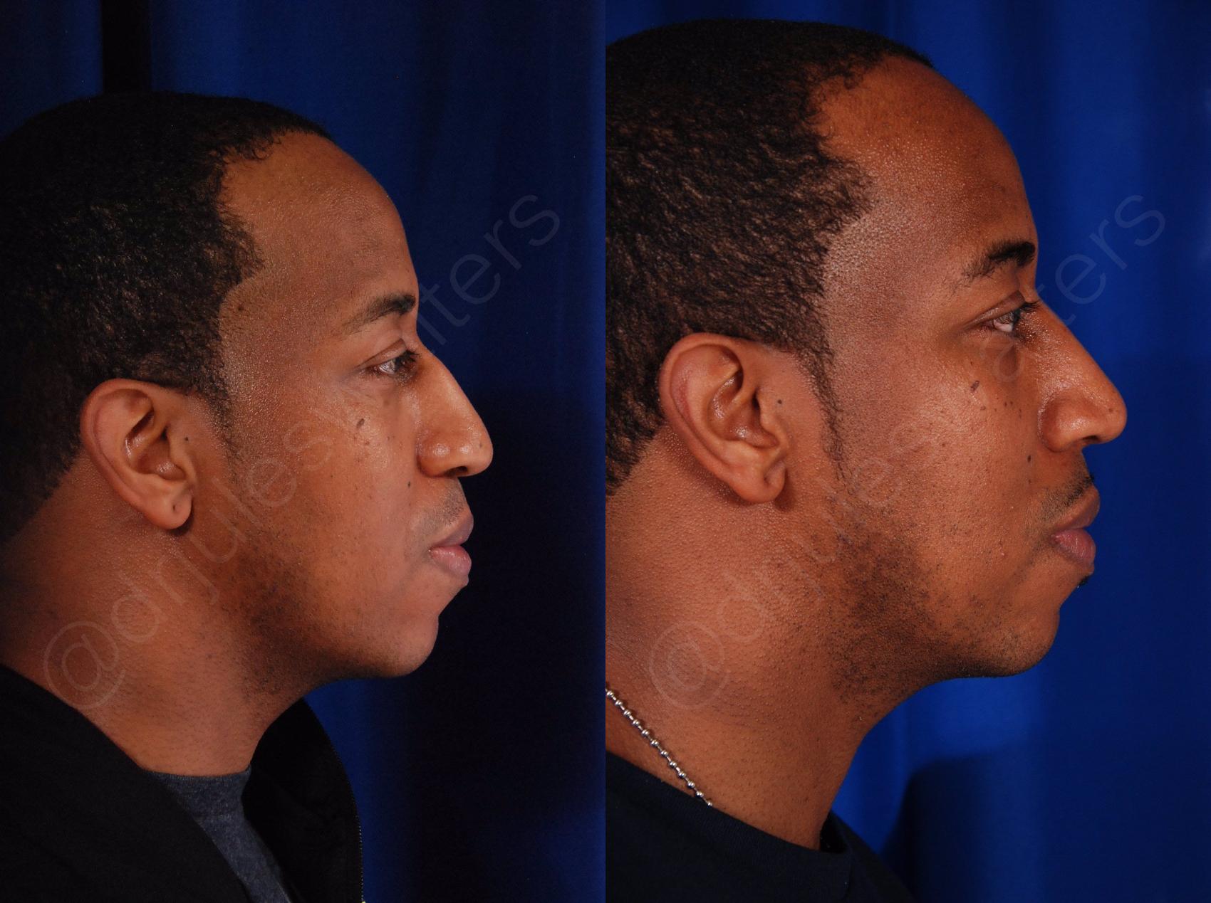 Before & After Rhinoplasty Case 138 View #1 View in Metairie, New Orleans, Covington, LA