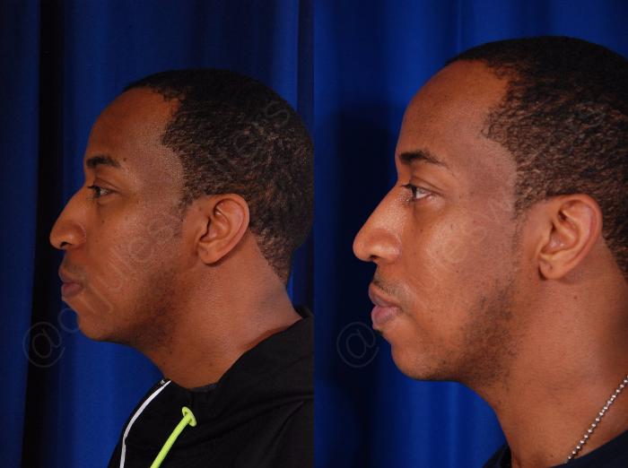 Before & After Rhinoplasty Case 138 View #2 View in Metairie and New Orleans, LA