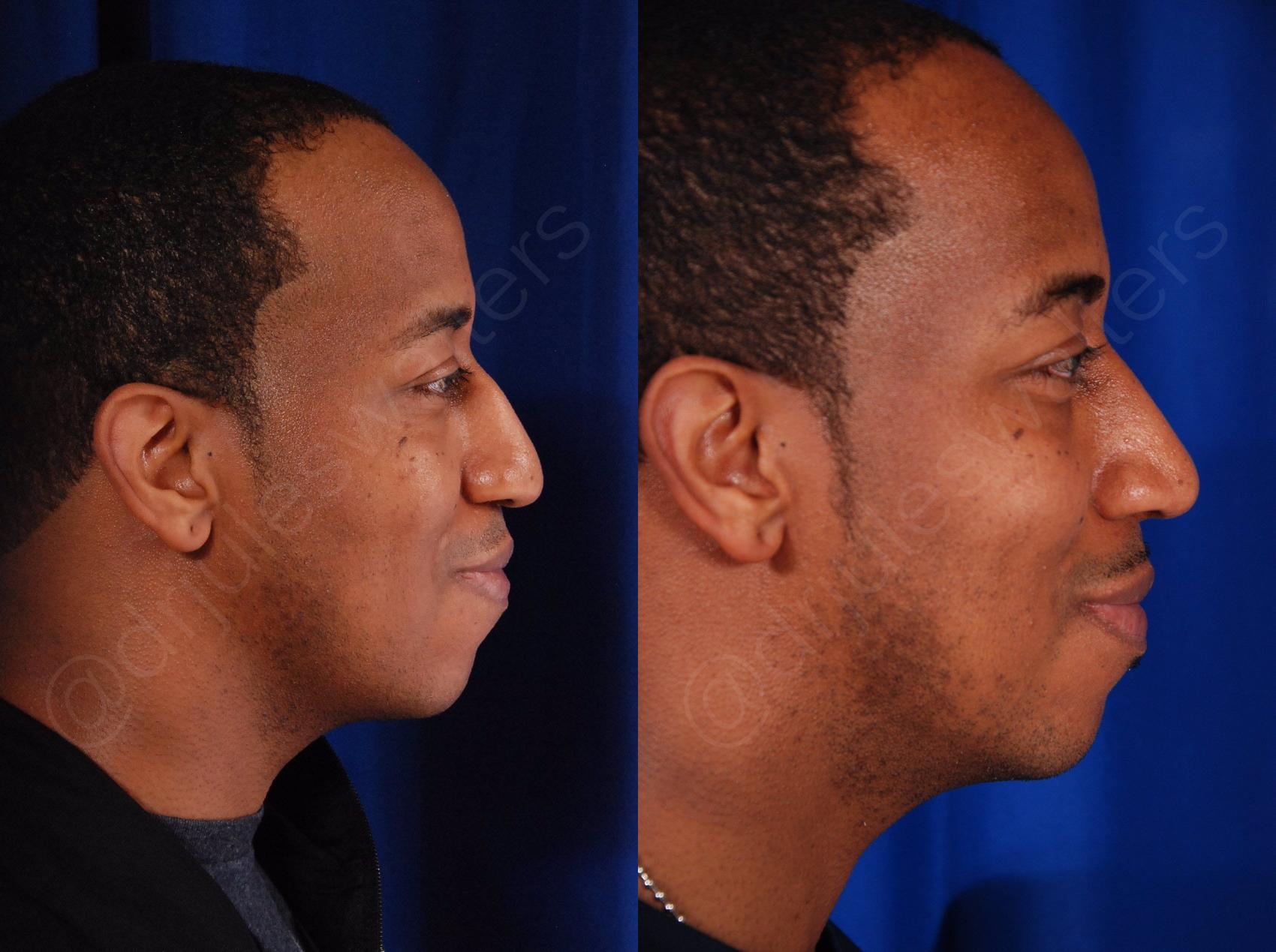 Before & After Rhinoplasty Case 138 View #3 View in Metairie and New Orleans, LA