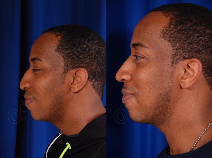 Before & After Rhinoplasty Case 138 View #4 View in Metairie and New Orleans, LA