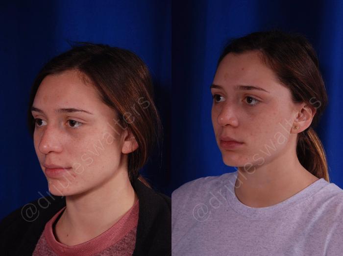 Before & After Rhinoplasty Case 139 View #2 View in Metairie and New Orleans, LA
