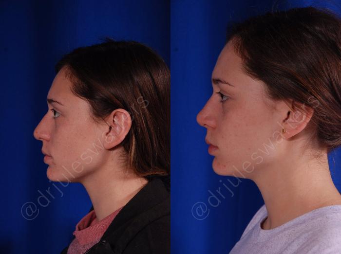 Before & After Rhinoplasty Case 139 View #3 View in Metairie and New Orleans, LA