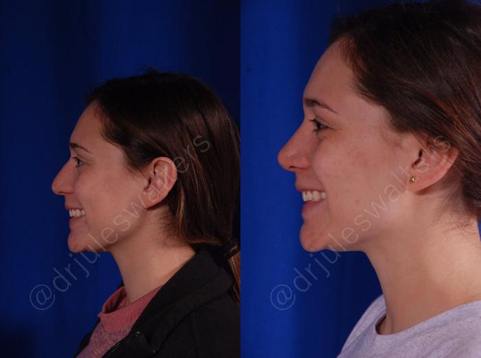 Before & After Rhinoplasty Case 139 View #4 View in Metairie and New Orleans, LA