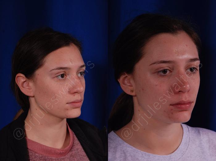 Before & After Rhinoplasty Case 139 View #5 View in Metairie and New Orleans, LA