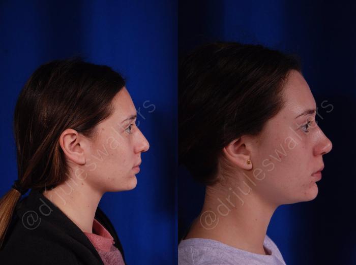 Before & After Rhinoplasty Case 139 View #6 View in Metairie and New Orleans, LA