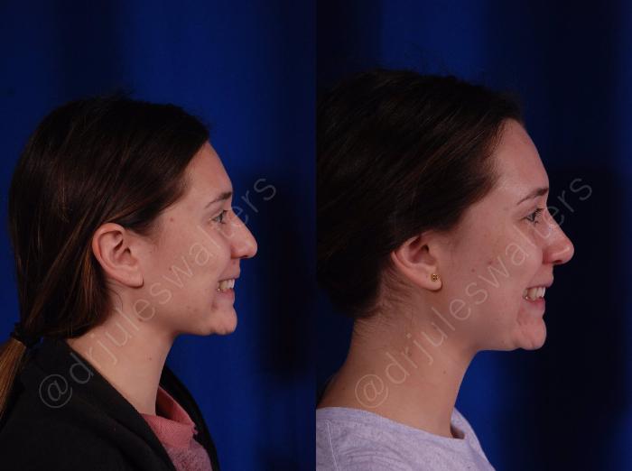 Before & After Rhinoplasty Case 139 View #7 View in Metairie and New Orleans, LA
