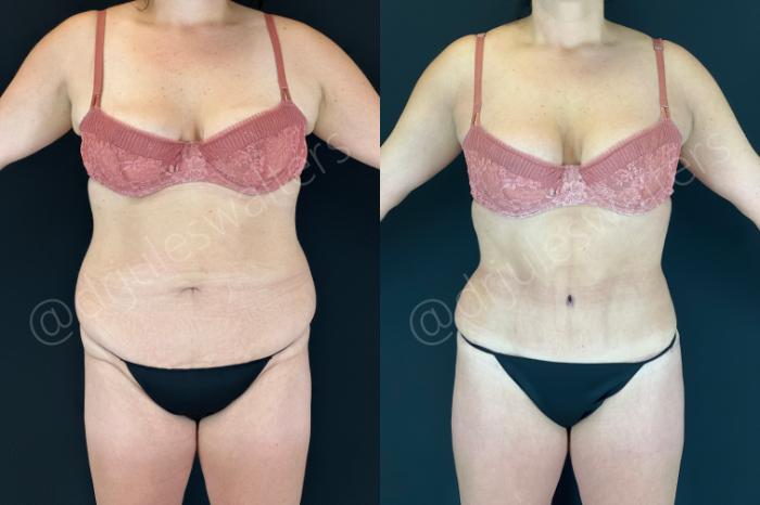 Before & After Tummy Tuck Case 152 Front View in Metairie and New Orleans, LA