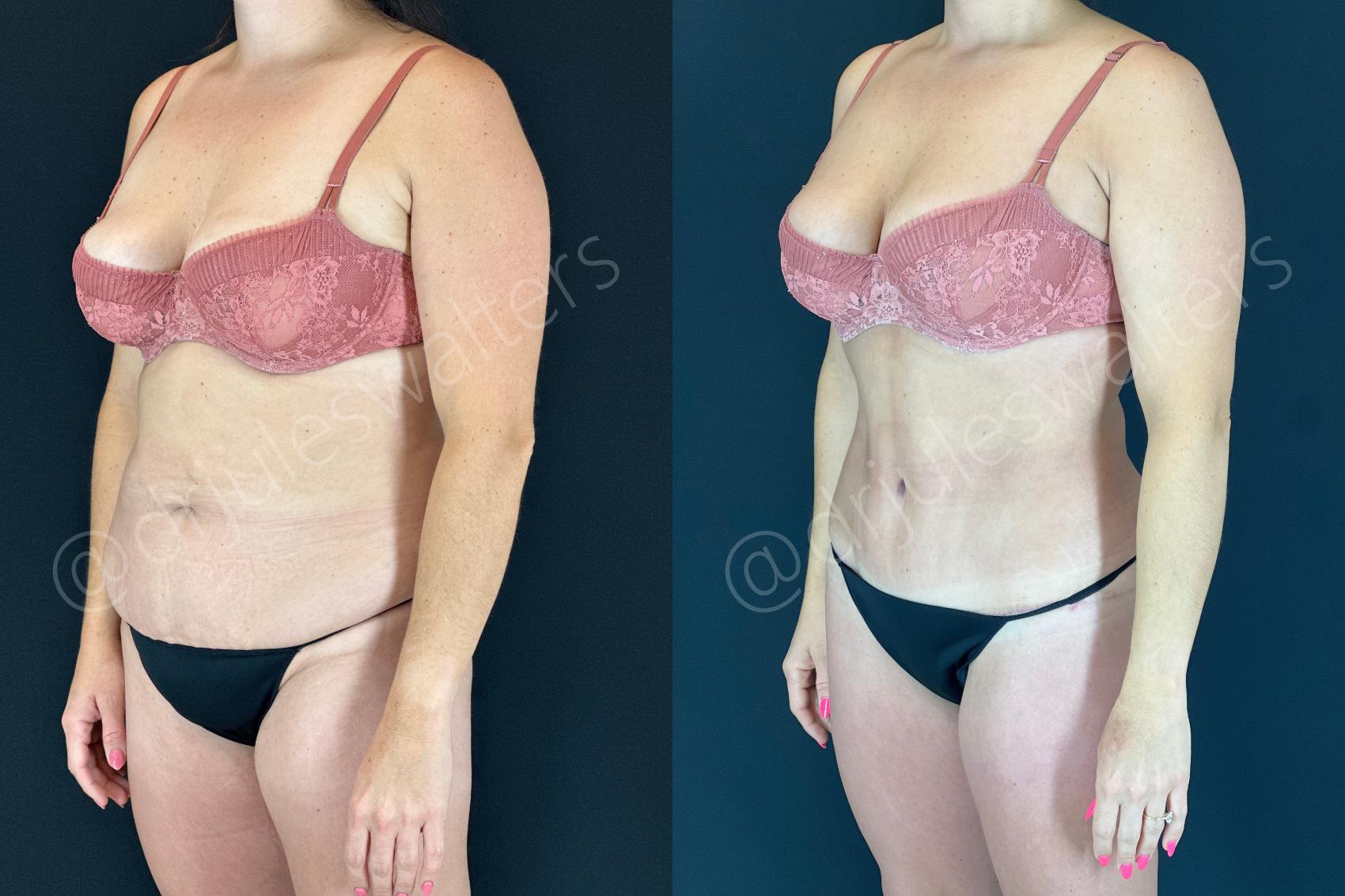 Before & After Tummy Tuck Case 152 Left Oblique View in Metairie and New Orleans, LA