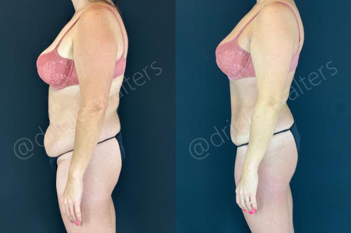 Before & After Tummy Tuck Case 152 Left Side View in Metairie and New Orleans, LA