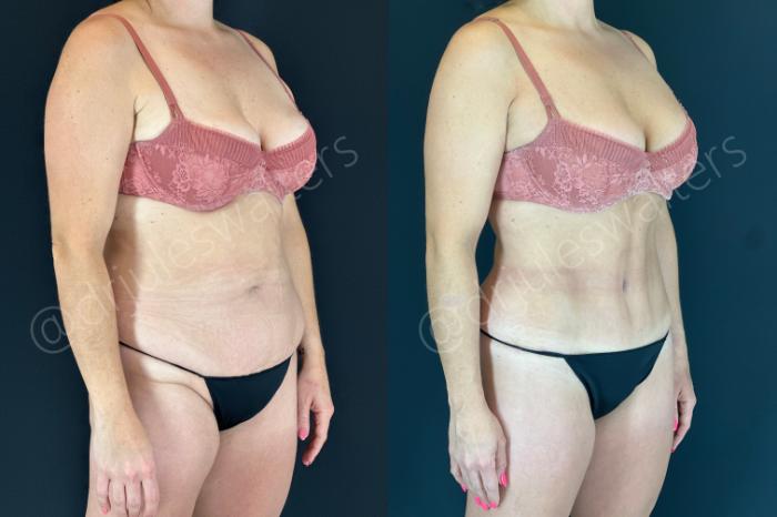 Before & After Tummy Tuck Case 152 Right Oblique View in Metairie and New Orleans, LA