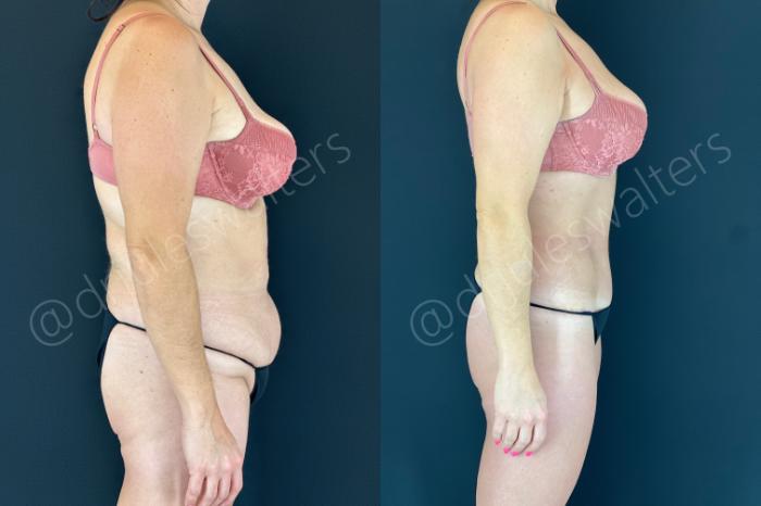 Before & After Tummy Tuck Case 152 Right Side View in Metairie and New Orleans, LA
