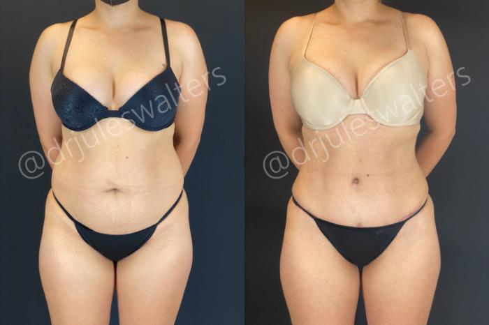 Before & After Liposuction Case 165 Front View in Metairie and New Orleans, LA